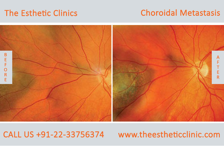 Choroidal Metastasis Eye Cancer Treatment before after photos in mumbai india (3)